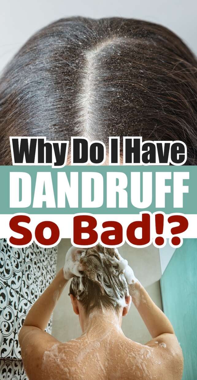 Why Do I Have Dandruff So Bad?