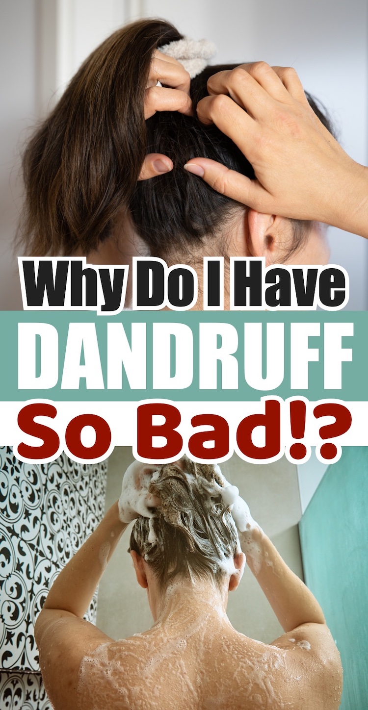 How to get rid of dandruff fast! Dandruff is a common medical condition in your scalp, beard and even eyebrows. This pesky problem is easy to fix with just a few easy remedies! From shampoo and apple cider vinegar to your diet and hydration levels. 