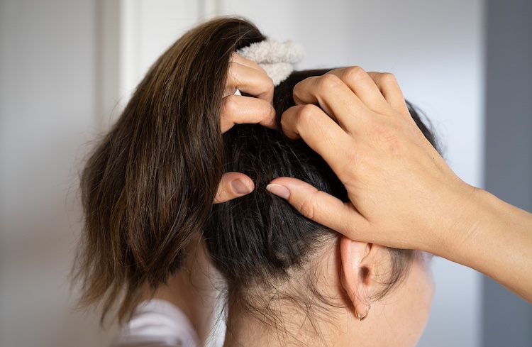 Genetics and your personal body chemistry plays a big role into whether you're prone to dandruff or not. Some people produce a lot more oil in their scalp which is basically food for yeast. 