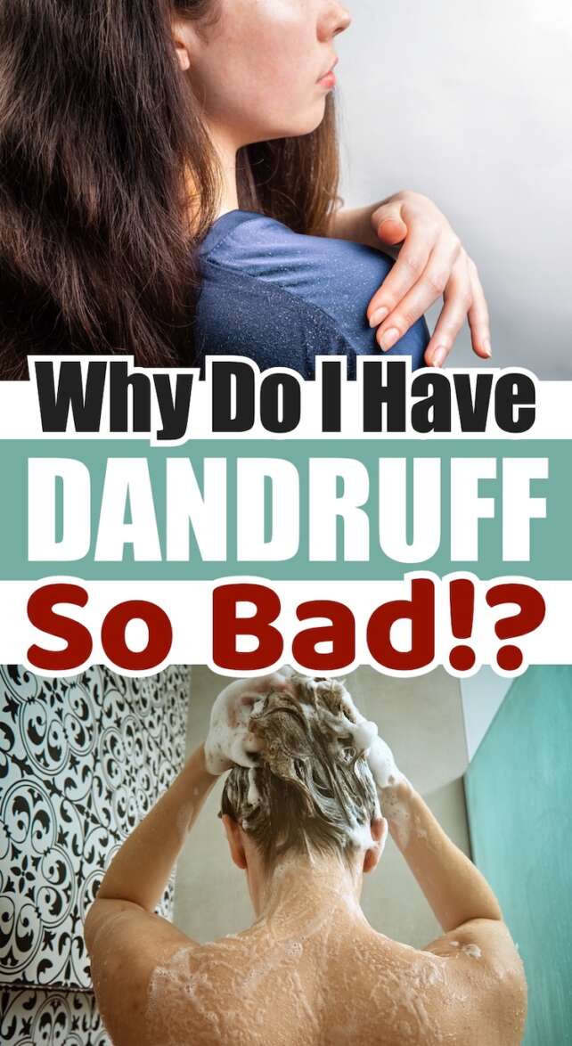 Why Do I Have Dandruff So Bad?